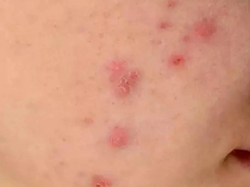 Tìm hiểu thêm hình ảnh bệnh đậu mùa qua bộ bệnh đậu mùa khỉ hình ảnh