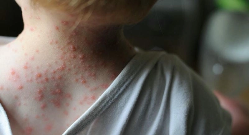 Nhận diện sớm qua hình ảnh bệnh đậu mùa và đậu mùa khỉ hình ảnh