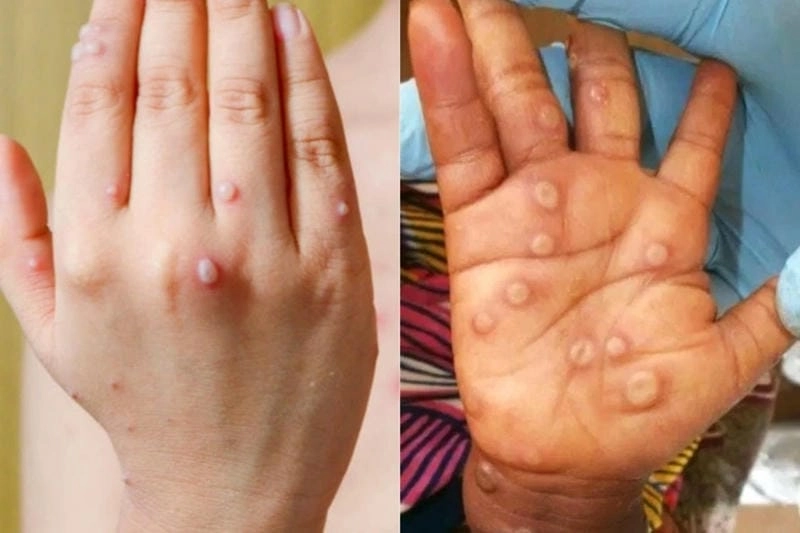 Cảnh báo qua các hình ảnh bệnh đậu mùa trong loạt ảnh bệnh đậu mùa