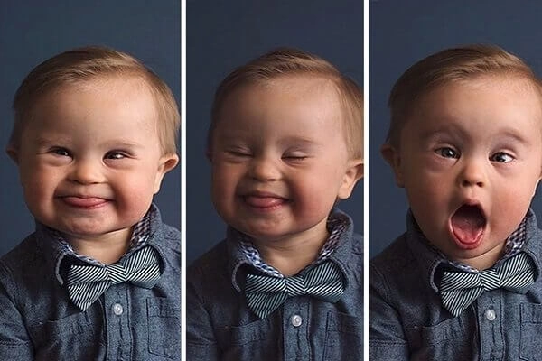 Khám phá chân dung người bị bệnh đao