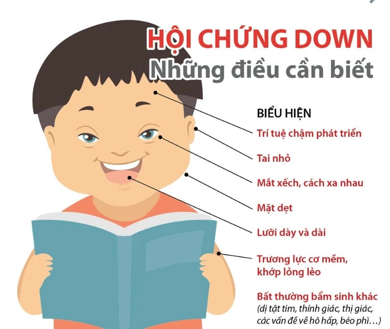 Xem kỹ hình ảnh người bị bệnh down mới nhất