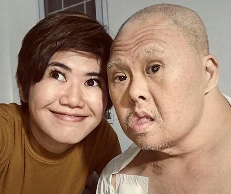 Tìm hiểu về bệnh down thể khảm hiếm gặp