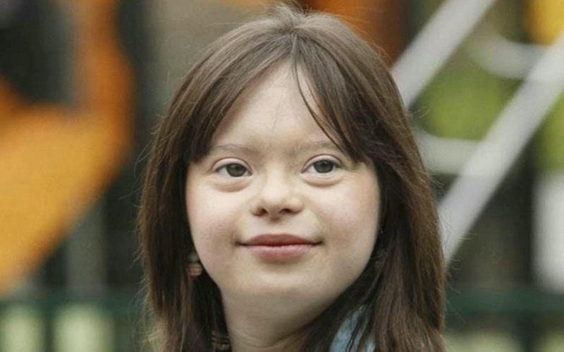 Khám phá hình ảnh bệnh down chân thực