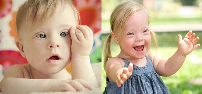 Tìm hiểu ảnh hưởng nhiễm sắc thể down
