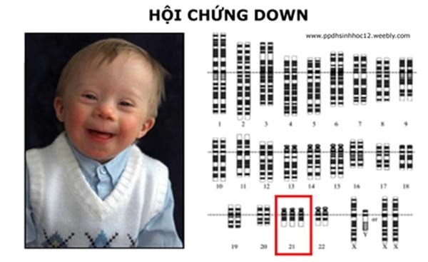 Hình ảnh người mắc hội chứng down chân thực