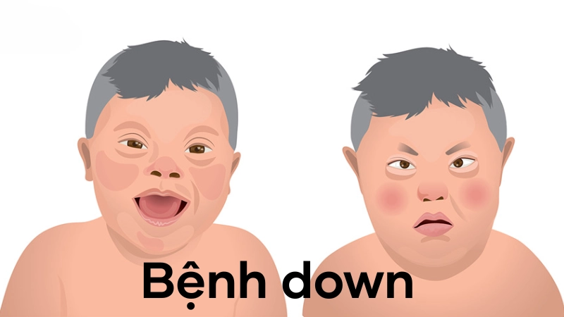 Hình ảnh bệnh down là như thế nào