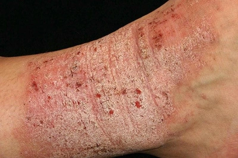 Khám phá bệnh eczema qua hình ảnh thực tế