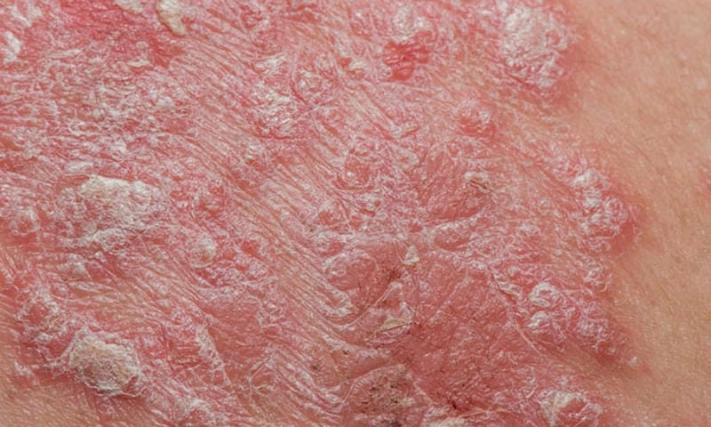 Quan sát triệu chứng ở người bị eczema qua hình ảnh