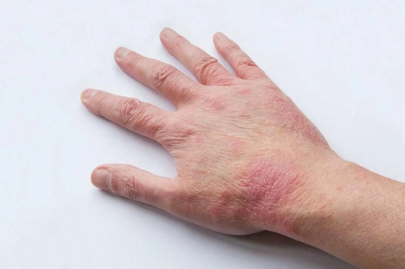 Dấu hiệu eczema đồng tiền được minh họa bằng ảnh