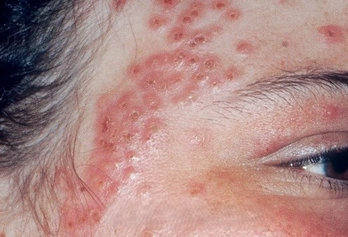 Cập nhật hình ảnh thực tế về eczema viêm loét dễ hiểu