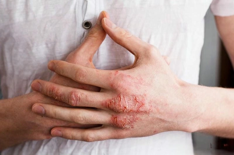 Xem hình ảnh người bị bệnh eczema rõ nét dễ hiểu