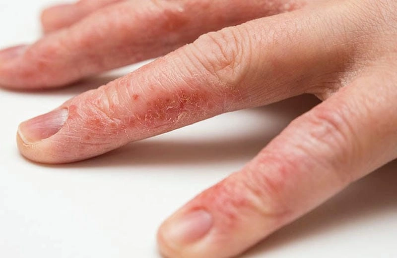 Hình ảnh giải thích rõ benh eczema la gi dễ hiểu