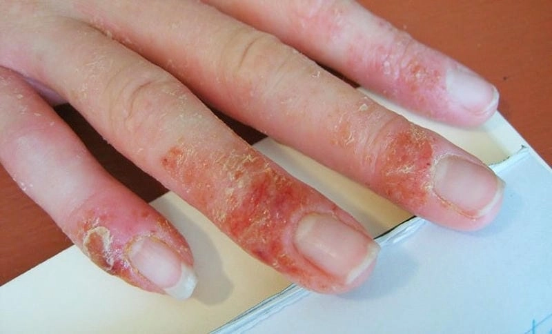 Tổng hợp hình ảnh bệnh nấm eczema dễ nhận biết