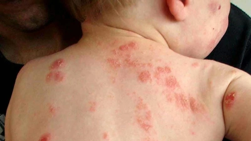Khám phá triệu chứng bệnh eczema to đỉa qua ảnh