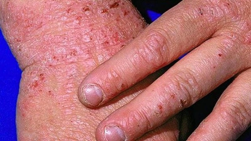 Tìm hiểu triệu chứng benh cham eczema qua ảnh