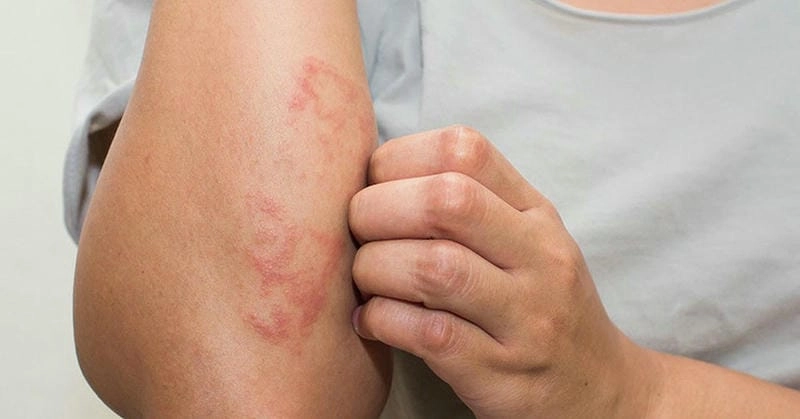 Tìm hiểu dấu hiệu eczema cấp tính qua hình ảnh minh họa