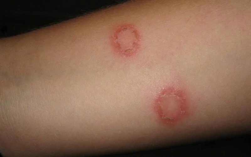 Hình ảnh minh họa eczema tái diễn dễ nhận biết và quan sát