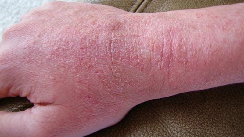 Ảnh tổng hợp triệu chứng eczema người lớn dễ phân biệt