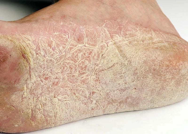 Triệu chứng eczema tái phát được minh họa bằng ảnh thực