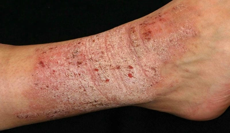 Quan sát dấu hiệu eczema nặng qua ảnh thực tế rõ nét