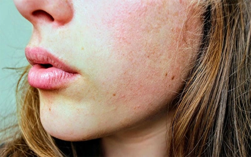 Cập nhật hình ảnh eczema viêm đỏ dễ nhận biết và hiểu rõ