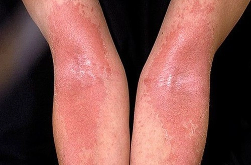 Quan sát dấu hiệu eczema đỏ da qua hình ảnh trực quan