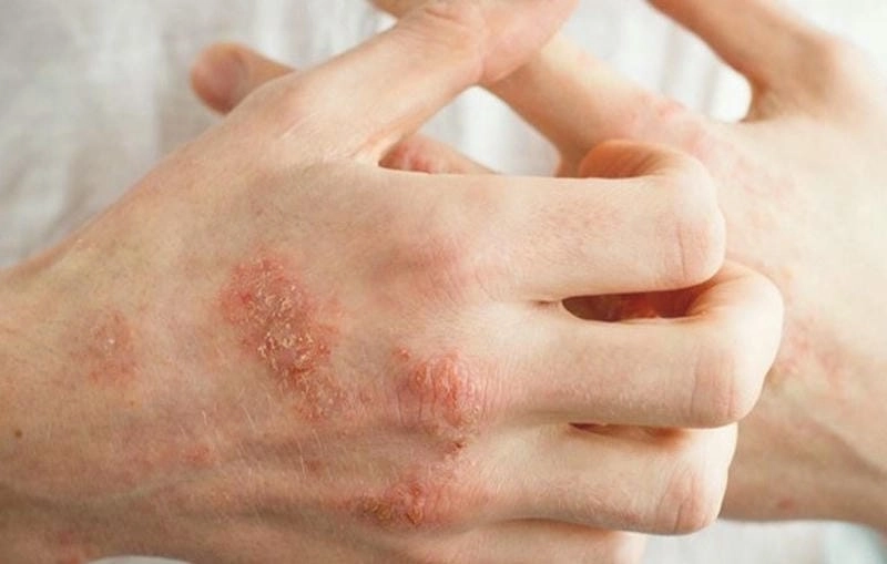 Nhận biết eczema thể đồng tiền qua ảnh rõ nét