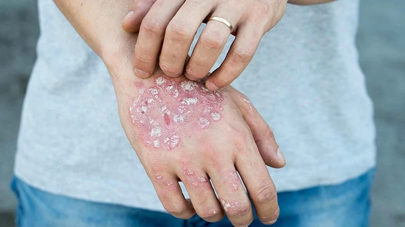 Cập nhật hình ảnh mới nhất về eczema vi khuẩn dễ hiểu