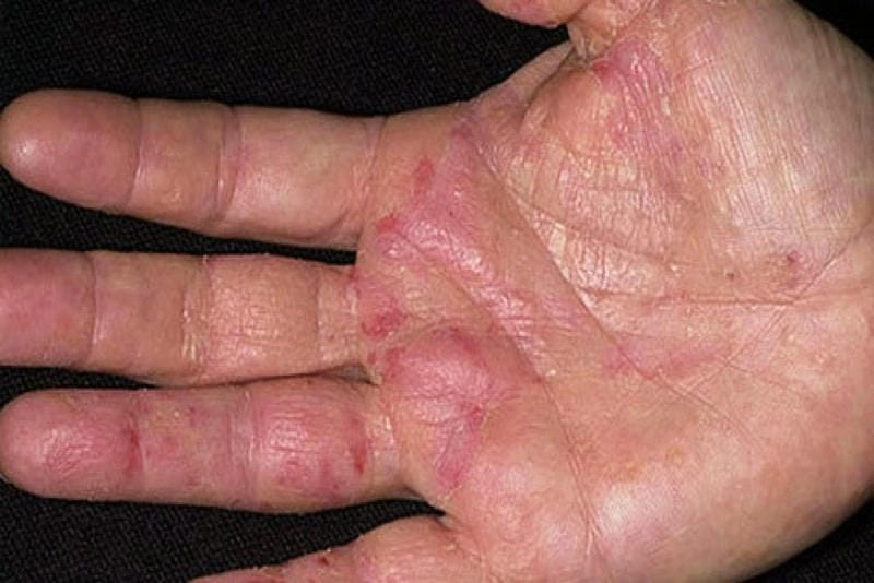 Hiểu rõ nguyên nhân gây bệnh eczema qua hình ảnh