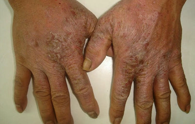 Nhận diện viêm da eczema dễ dàng bằng ảnh thực tế