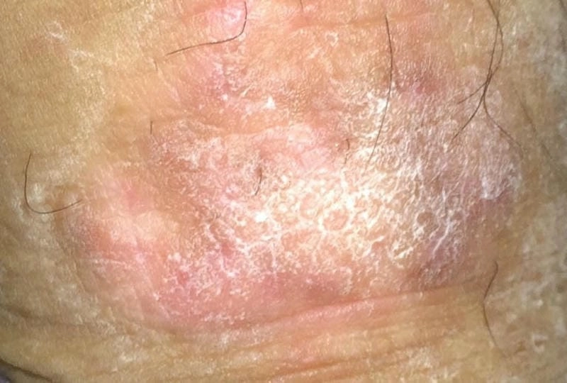 Tổng hợp ảnh bệnh eczema ở người rõ nét và chân thực