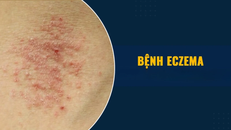 Hình ảnh bệnh eczema là như thế nào