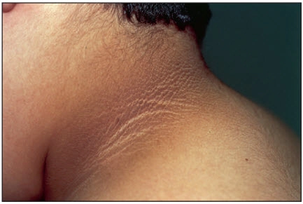 Xem kỹ hình ảnh bệnh gai đen trên da cổ rõ nét