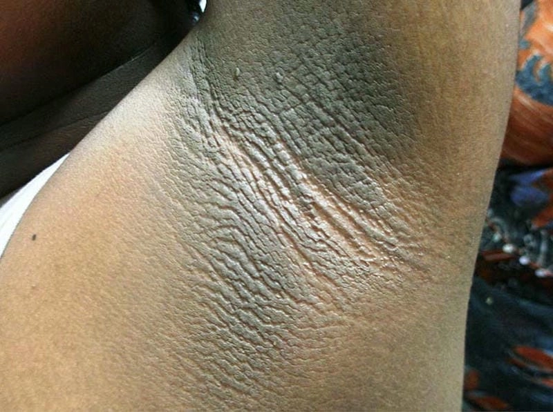 Chi tiết hình ảnh bệnh gai đen ở nách cần biết