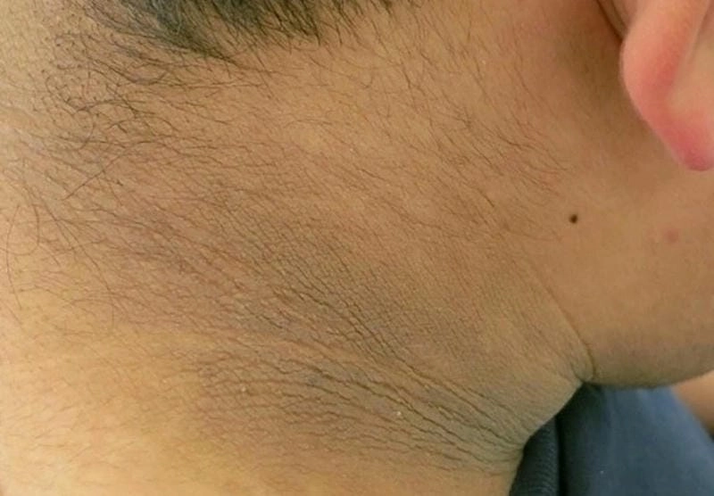 Xem kỹ hình ảnh bệnh gai đen ở gáy để nhận biết sớm