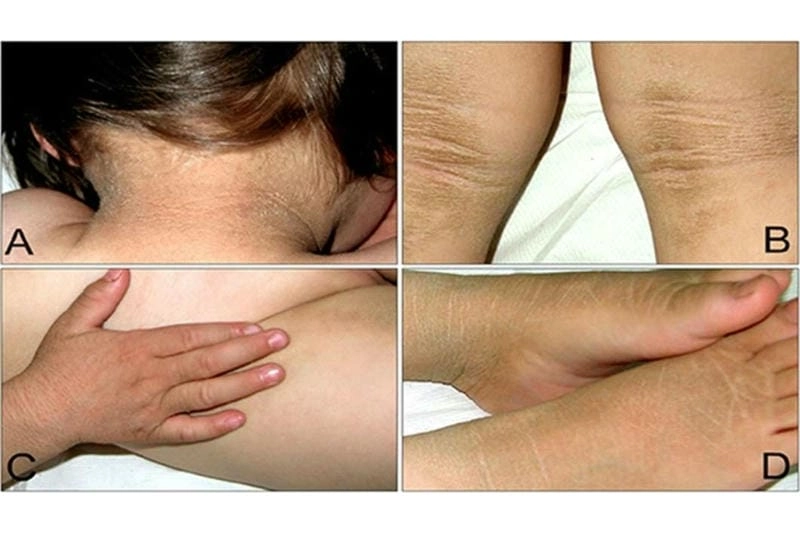 Khám phá hình ảnh bệnh gai đen chi tiết dễ hiểu