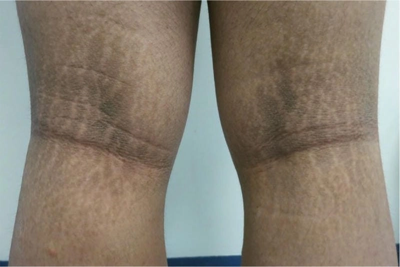 Khám phá hình ảnh bệnh gai đen ở da theo từng vùng