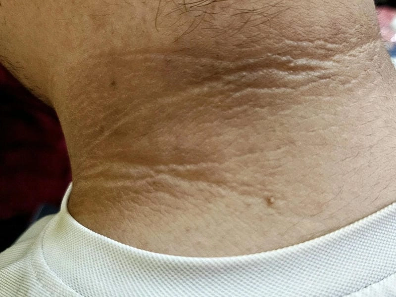 Nhận biết sớm bệnh gai đen ở cổ và cách phòng