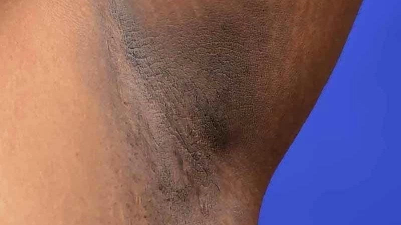 Khám phá hình ảnh bệnh gai đen chưa điều trị rõ nét