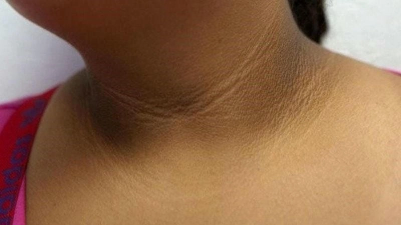 Cảnh báo sớm triệu chứng bệnh gai đen cổ phổ biến