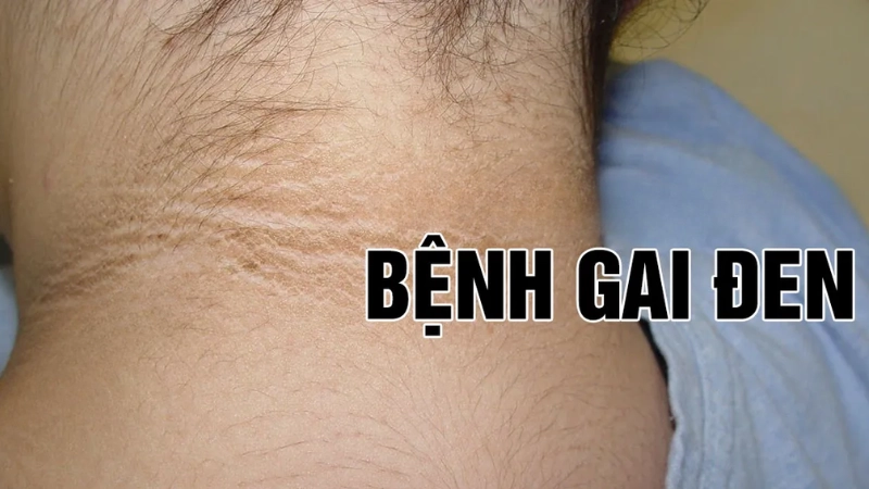 Bệnh gai đen là như thế nào bạn biết chưa