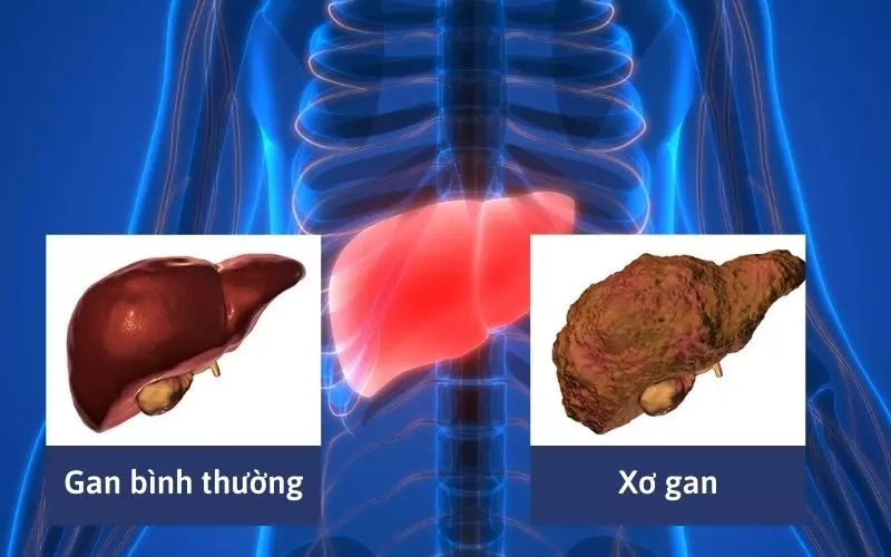 Cảnh báo sớm qua hình ảnh gan xơ hóa thực tế