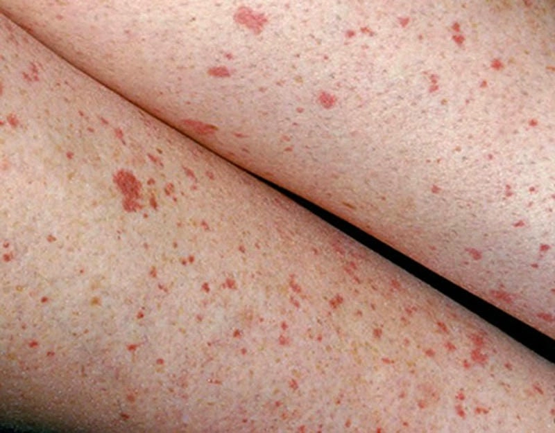 Thực tế ảnh bệnh gan ở người lớn qua ảnh chụp y học