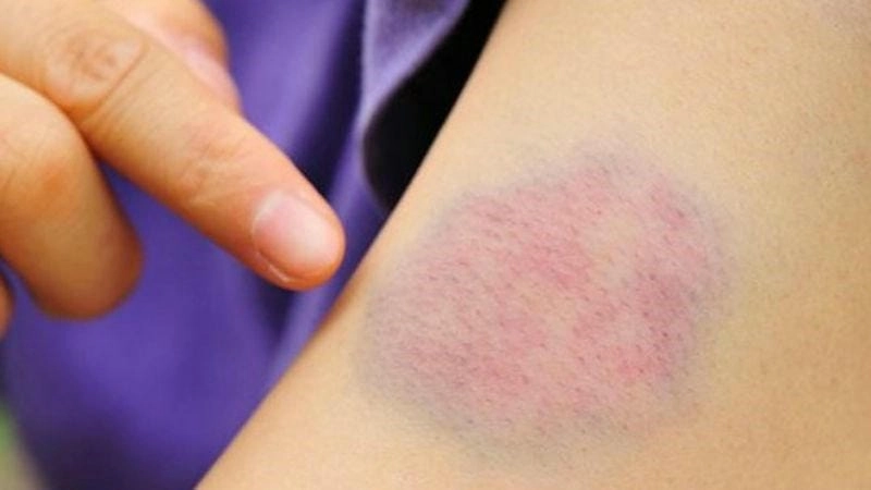 Nhận biết hình ảnh trẻ bị bệnh gan qua triệu chứng