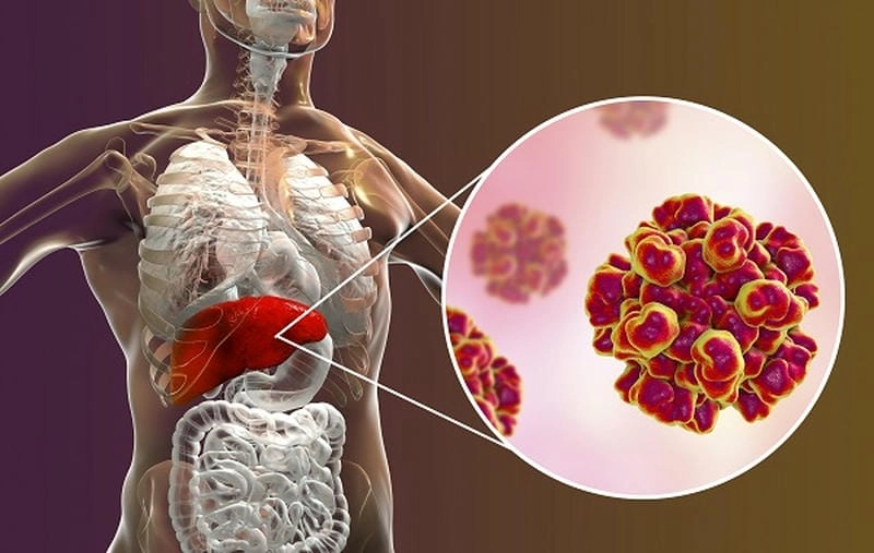 Tổng hợp bệnh gan hình ảnh từ nhẹ đến nặng