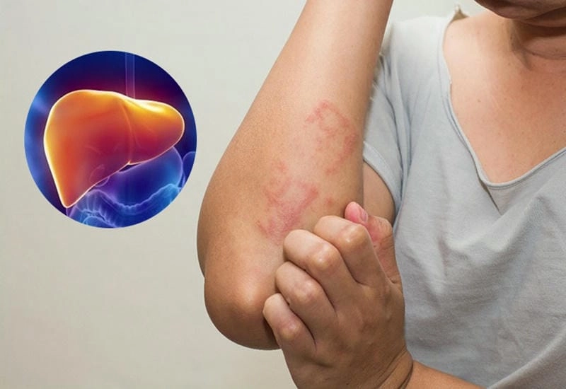 Hiểu rõ viêm gan c qua các hình ảnh bệnh lý