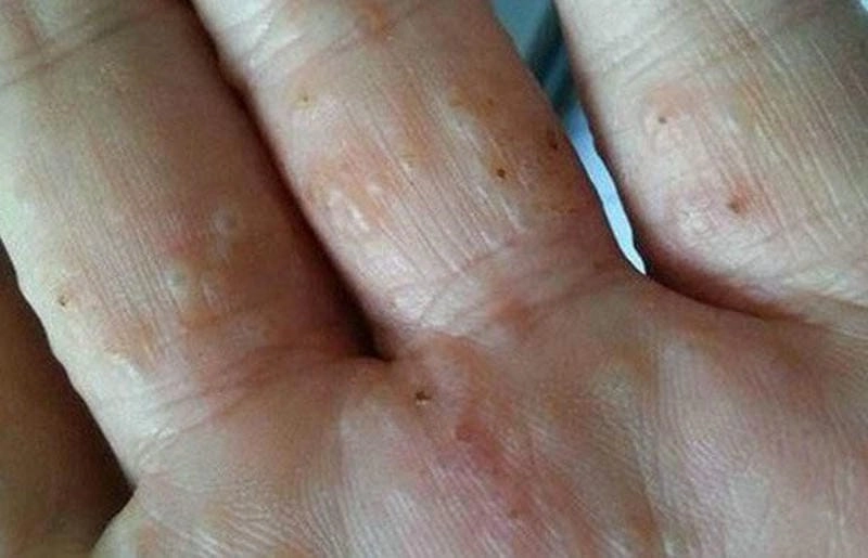 Ảnh người bị bệnh ghẻ ghi lại vùng da bị viêm