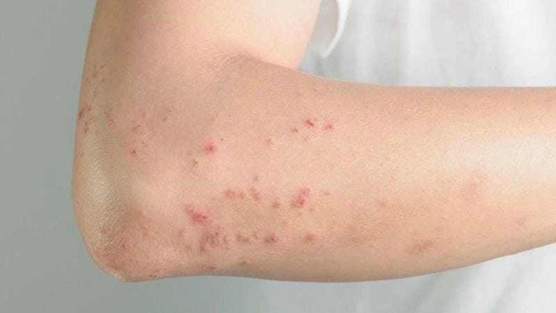 Ảnh trẻ bị bệnh ghẻ thường tập trung ở tay chân