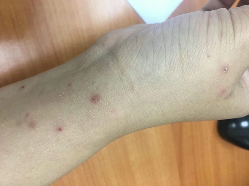 Xem rõ hơn triệu chứng qua ảnh bị ghẻ