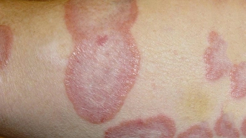 Hình ảnh bị ghẻ ngứa thể hiện rõ vùng tổn thương